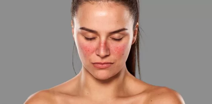 ugonjwa wa lupus