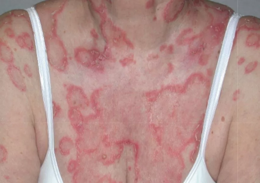 ugonjwa wa lupus